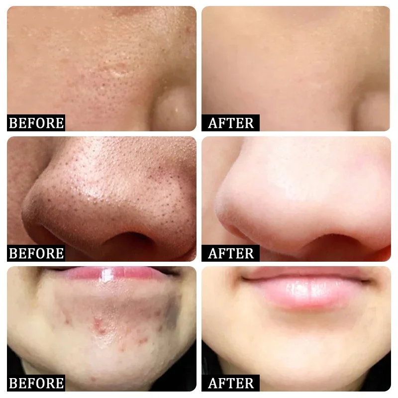 Salicylic Acid Pore Clearing C - Azelaic Acid Cream บทวิจารณ์และราคา