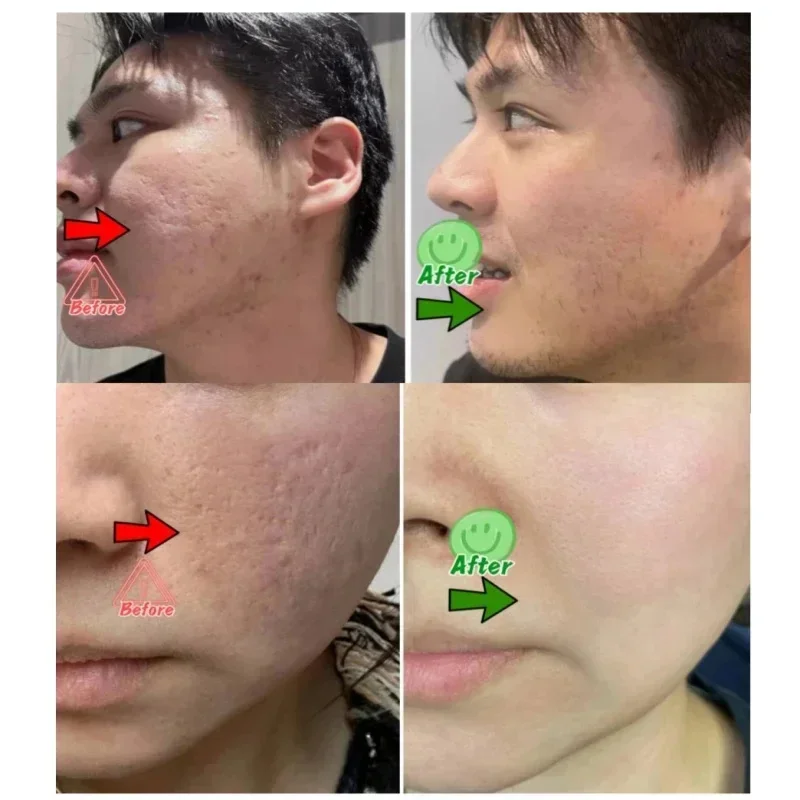 Salicylic Acid Pore Clearing C - Azelaic Acid Cream บทวิจารณ์และราคา