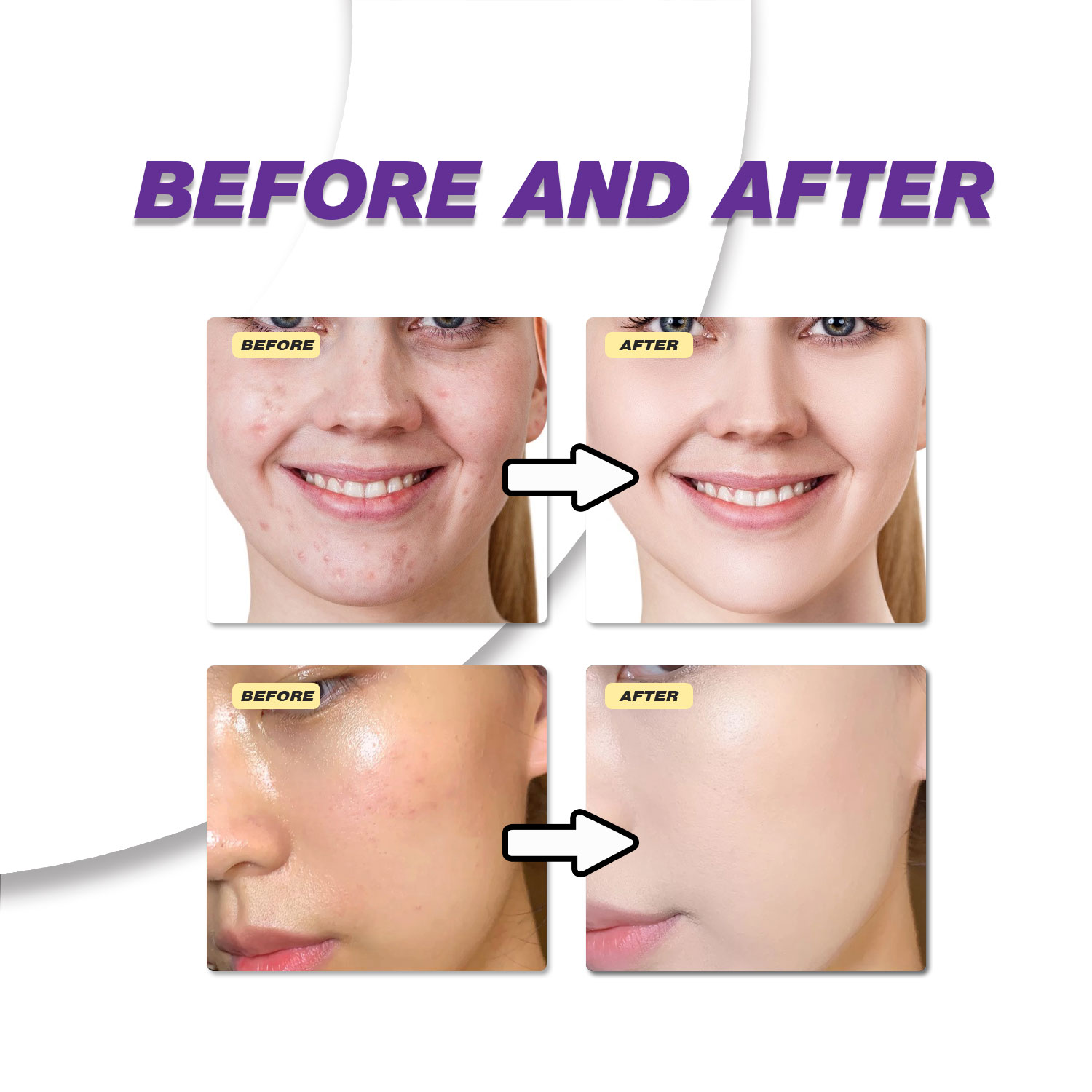 ครีมกรดอะซีเลอิกสูตรอ่อนโยน ช่ - Azelaic Acid Cream บทวิจารณ์และราคา
