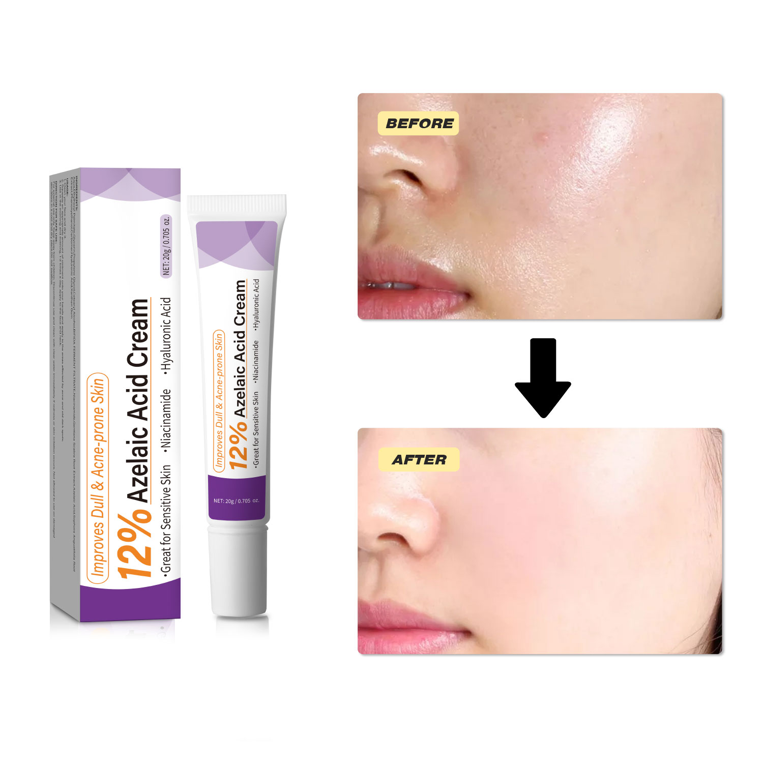 ครีมกรดอะซีเลอิกสูตรอ่อนโยน ช่ - Azelaic Acid Cream บทวิจารณ์และราคา